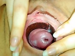 timid cervix