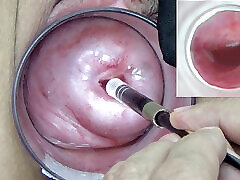 A endoscope japanese camera is inserted in the secunia borland to watch inside the uterus.