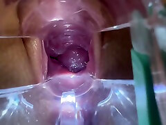 Cervix Close-up With Speculum